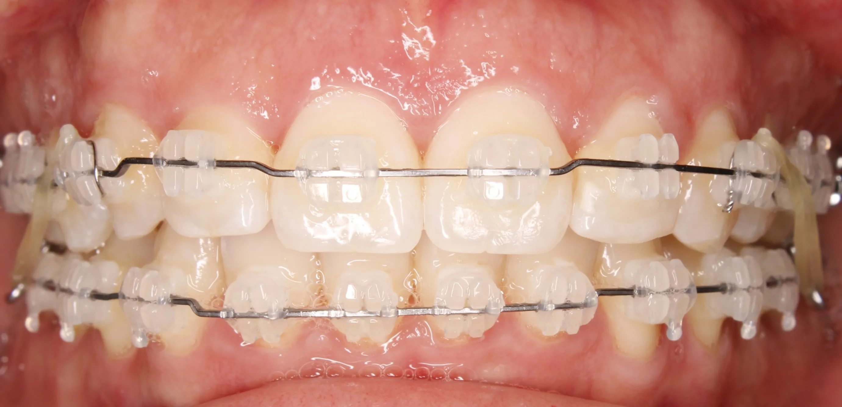 Brackets estéticos